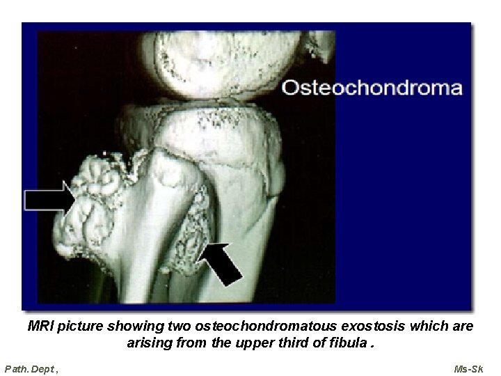 MRI picture showing two osteochondromatous exostosis which are arising from the upper third of MRI picture showing two osteochondromatous exostosis which are arising from the upper third of