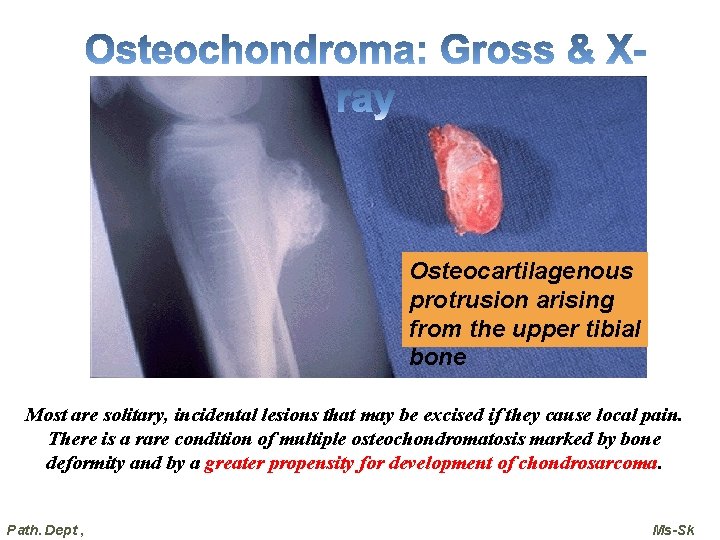 Osteocartilagenous protrusion arising from the upper tibial bone Most are solitary, incidental lesions that Osteocartilagenous protrusion arising from the upper tibial bone Most are solitary, incidental lesions that