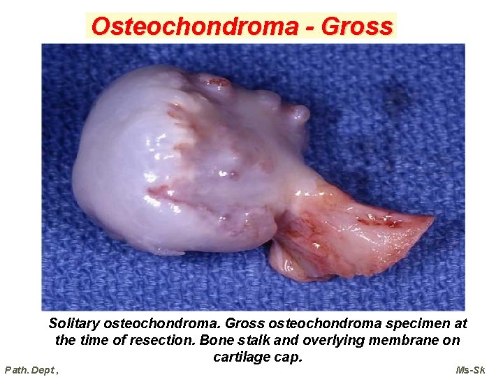Osteochondroma - Gross Solitary osteochondroma. Gross osteochondroma specimen at the time of resection. Bone Osteochondroma - Gross Solitary osteochondroma. Gross osteochondroma specimen at the time of resection. Bone