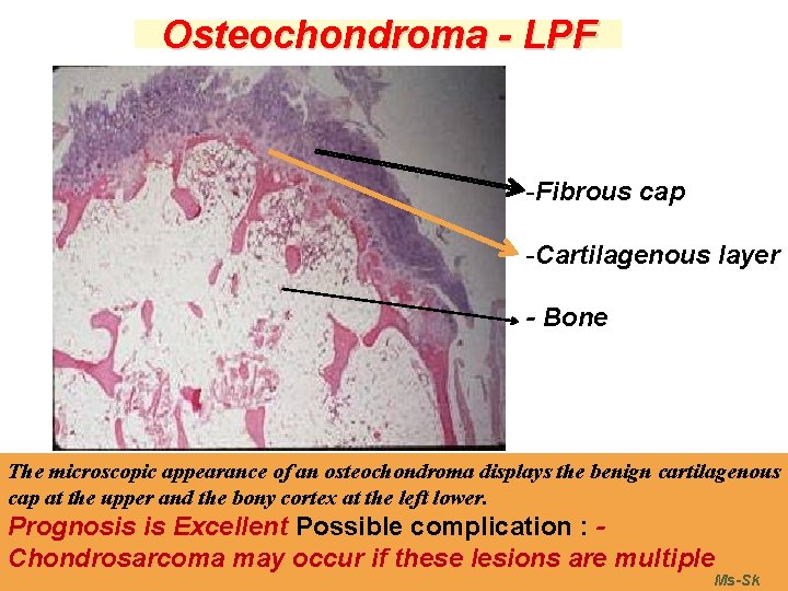 Osteochondroma - LPF -Fibrous cap -Cartilagenous layer - Bone The microscopic appearance of an Osteochondroma - LPF -Fibrous cap -Cartilagenous layer - Bone The microscopic appearance of an