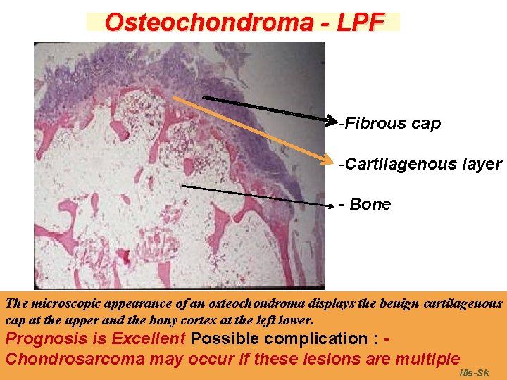 Osteochondroma - LPF -Fibrous cap -Cartilagenous layer - Bone The microscopic appearance of an