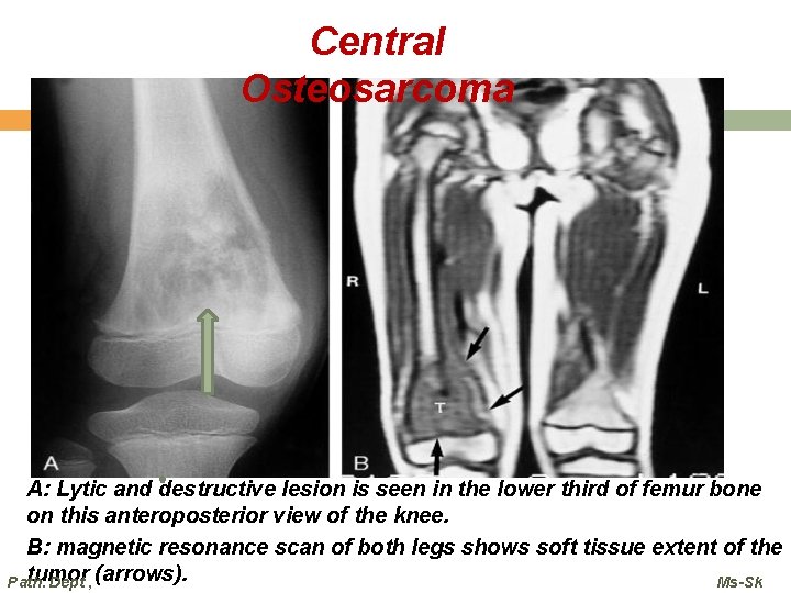 Central Osteosarcoma A: Lytic and destructive lesion is seen in the lower third of Central Osteosarcoma A: Lytic and destructive lesion is seen in the lower third of