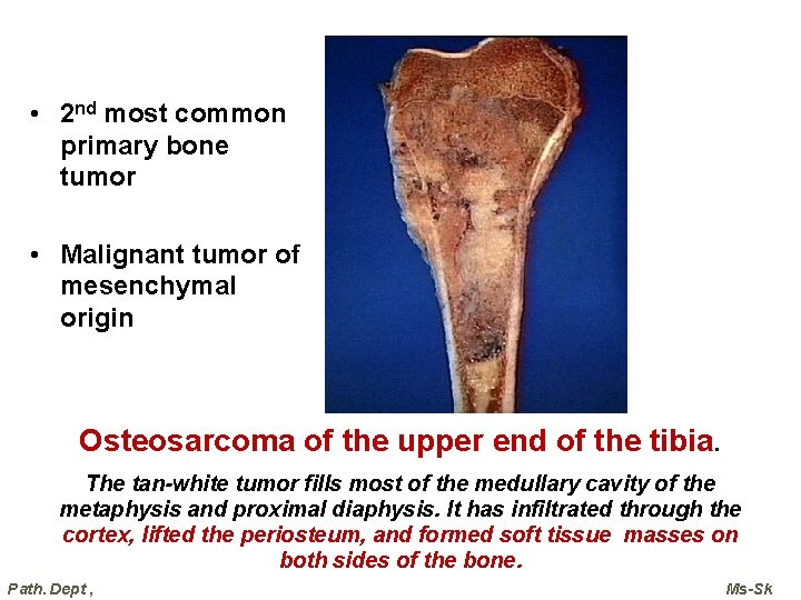  • 2 nd most common primary bone tumor • Malignant tumor of mesenchymal