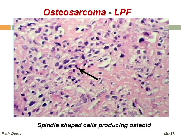 Osteosarcoma - LPF Spindle shaped cells producing osteoid Path. Dept , Ms-Sk  Osteosarcoma - LPF Spindle shaped cells producing osteoid Path. Dept , Ms-Sk