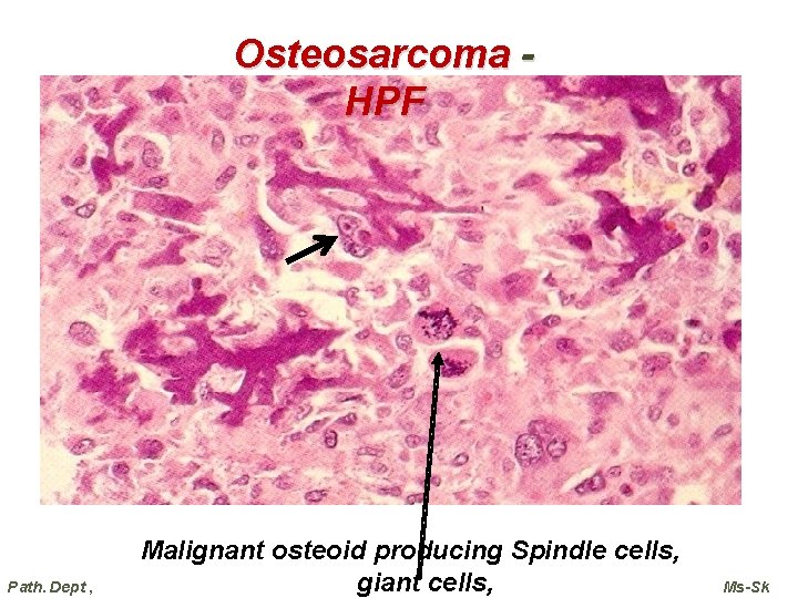 Osteosarcoma HPF Path. Dept , Malignant osteoid producing Spindle cells, giant cells, Ms-Sk  Osteosarcoma HPF Path. Dept , Malignant osteoid producing Spindle cells, giant cells, Ms-Sk