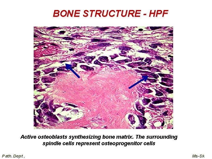 BONE STRUCTURE - HPF Active osteoblasts synthesizing bone matrix. The surrounding spindle cells represent