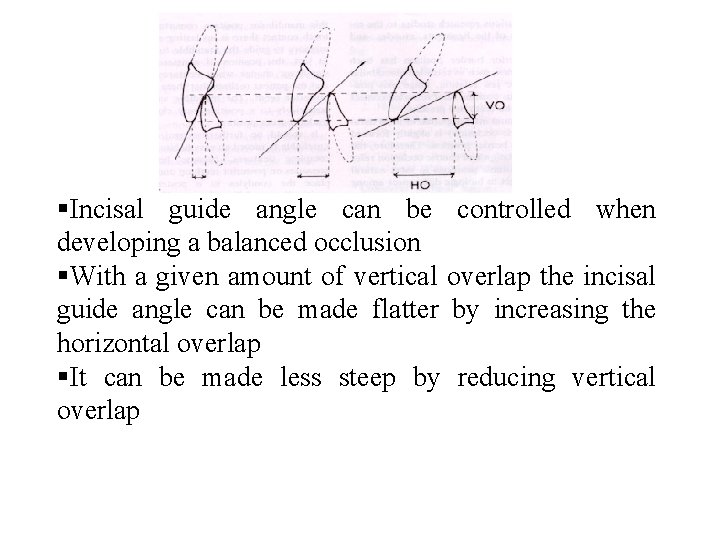  Incisal guide angle can be controlled when developing a balanced occlusion With a