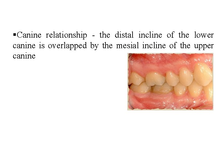  Canine relationship - the distal incline of the lower canine is overlapped by