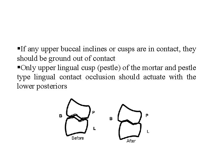  If any upper buccal inclines or cusps are in contact, they should be