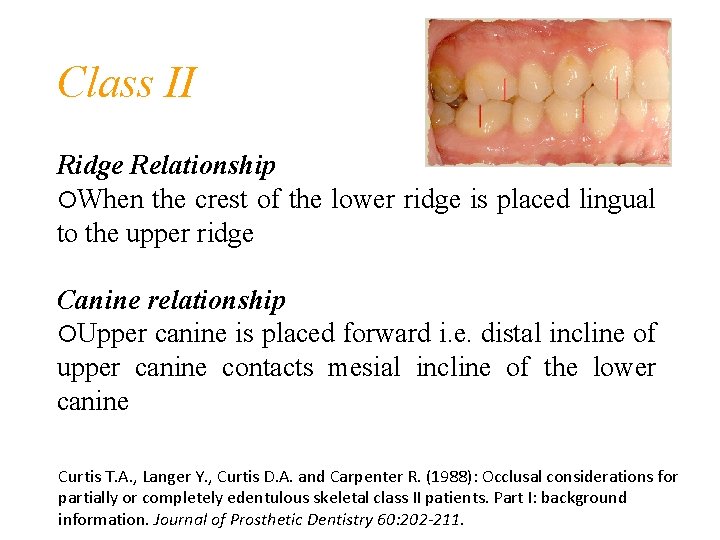 Class II Ridge Relationship When the crest of the lower ridge is placed lingual