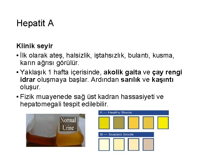 Hepatit A Klinik seyir • İlk olarak ateş, halsizlik, iştahsızlık, bulantı, kusma, karın ağrısı