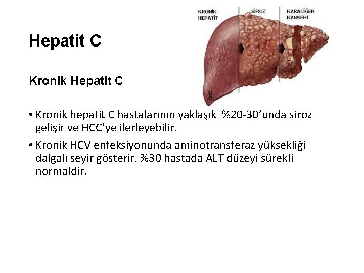 Hepatit C Kronik Hepatit C • Kronik hepatit C hastalarının yaklaşık %20 -30’unda siroz