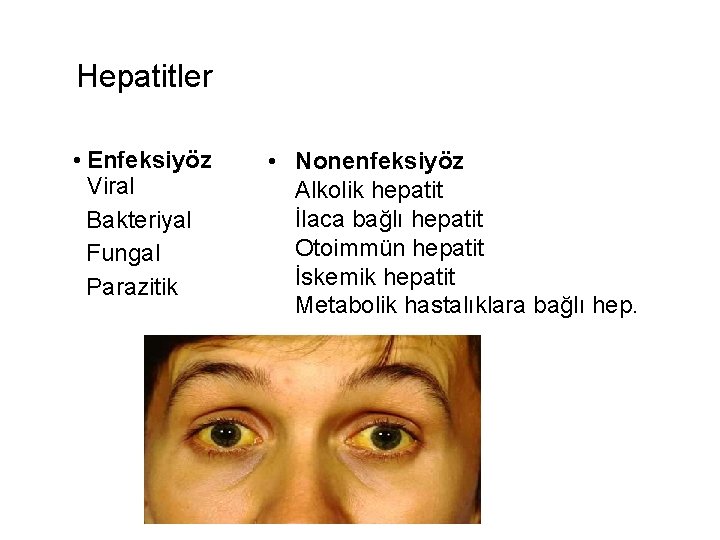 Hepatitler • Enfeksiyöz Viral Bakteriyal Fungal Parazitik • Nonenfeksiyöz Alkolik hepatit İlaca bağlı hepatit