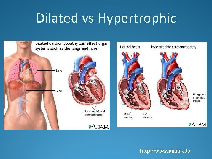 Dilated vs Hypertrophic http: //www. umm. edu 