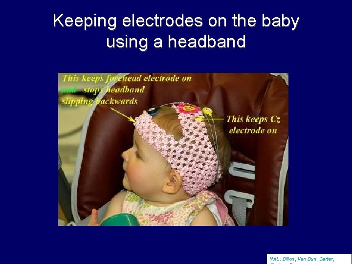 Keeping electrodes on the baby using a headband NAL: Dillon, Van Dun, Carter, 