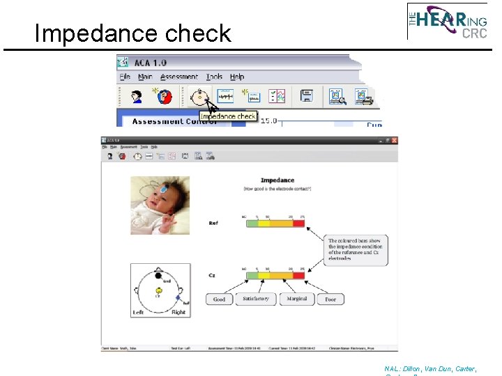 Impedance check NAL: Dillon, Van Dun, Carter, 