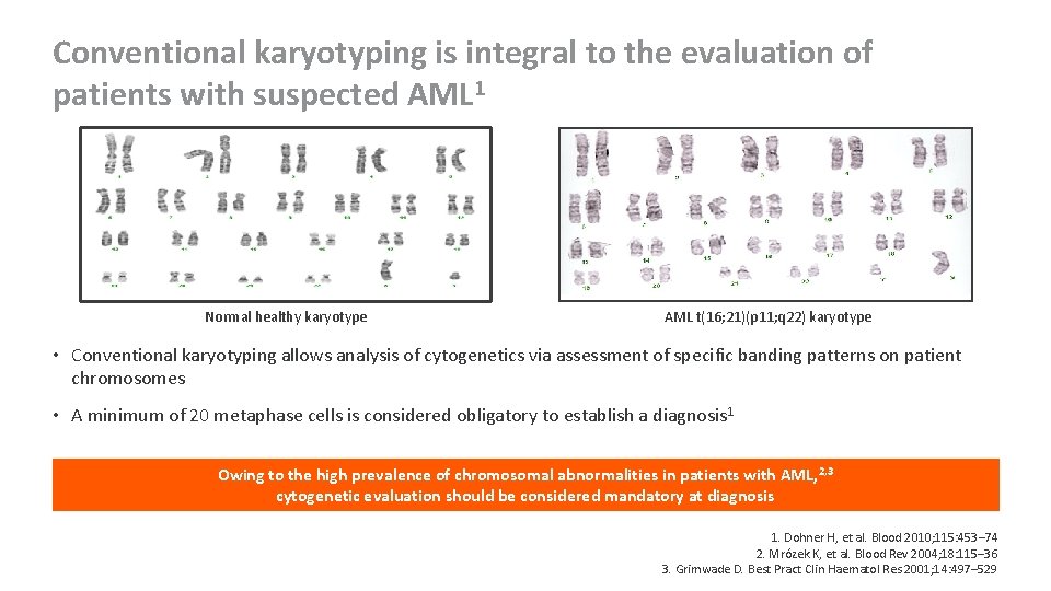 Conventional karyotyping is integral to the evaluation of patients with suspected AML 1 Normal