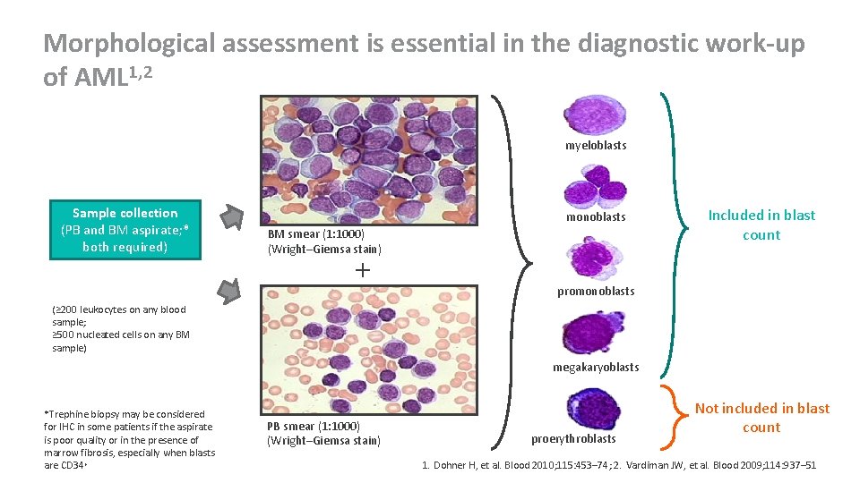 Morphological assessment is essential in the diagnostic work-up of AML 1, 2 myeloblasts Sample