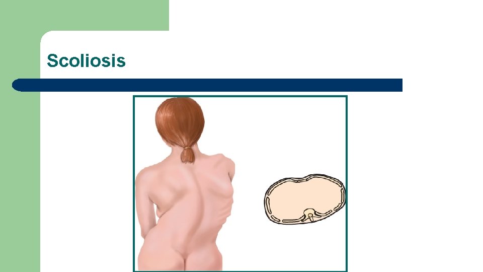 Scoliosis 