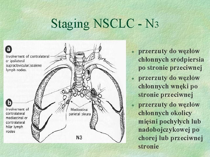 Staging NSCLC - N 3 l l l przerzuty do węzłów chłonnych sródpiersia po