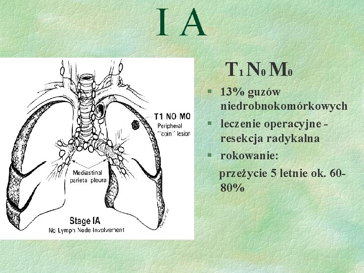 IA T 1 N 0 M 0 § 13% guzów niedrobnokomórkowych § leczenie operacyjne