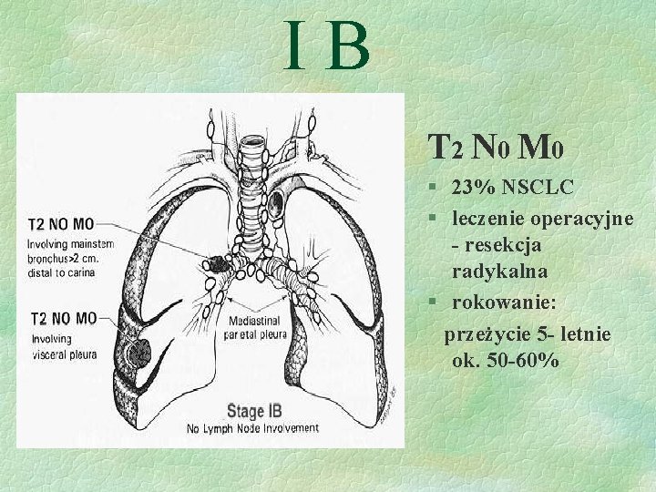 IB T 2 N 0 M 0 § 23% NSCLC § leczenie operacyjne -