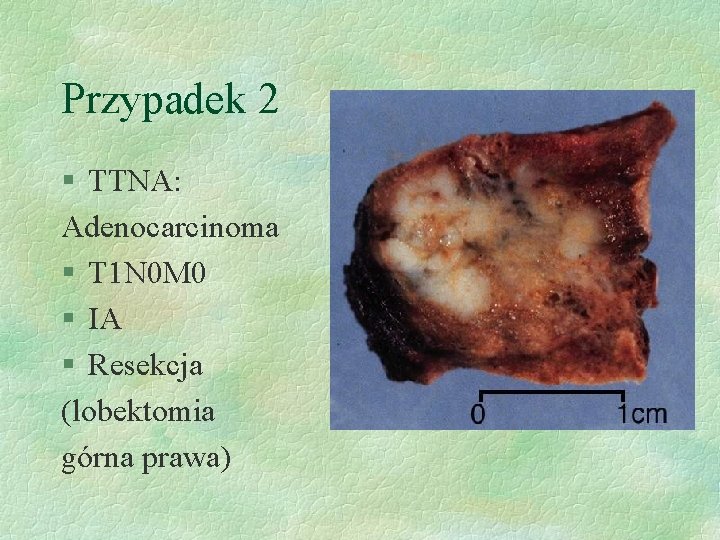 Przypadek 2 § TTNA: Adenocarcinoma § T 1 N 0 M 0 § IA