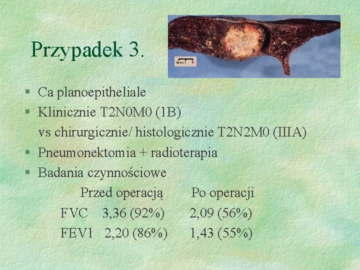 Przypadek 3. § Ca planoepitheliale § Klinicznie T 2 N 0 M 0 (1