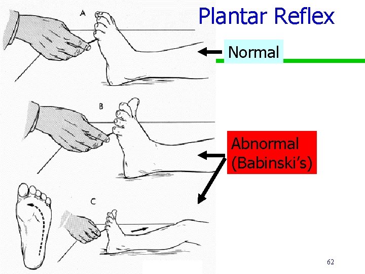 Plantar Reflex Normal Abnormal (Babinski’s) 62 