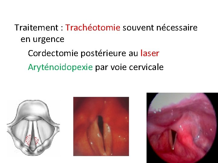 Traitement : Trachéotomie souvent nécessaire en urgence Cordectomie postérieure au laser Aryténoidopexie par voie