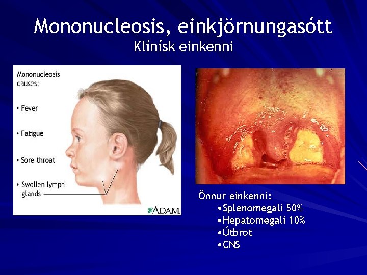 Mononucleosis, einkjörnungasótt Klínísk einkenni Önnur einkenni: • Splenomegali 50% • Hepatomegali 10% • Útbrot