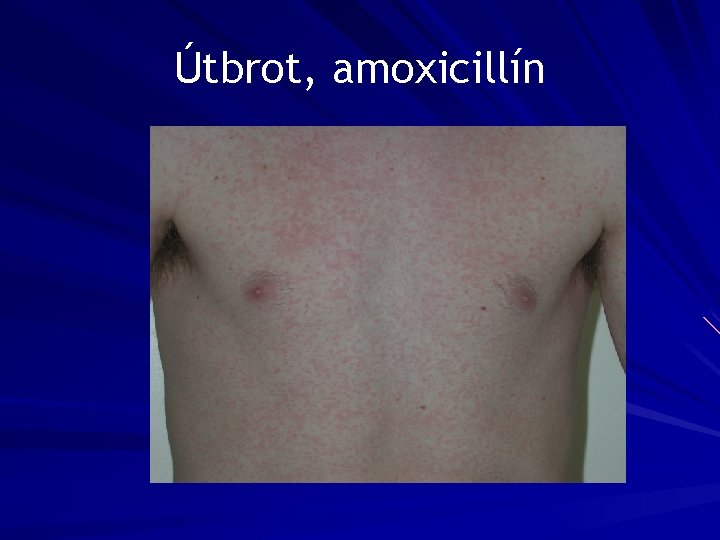 Útbrot, amoxicillín 