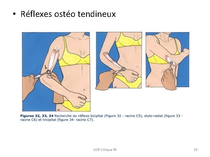  • Réflexes ostéo tendineux ISOP Clinique P 5 23 