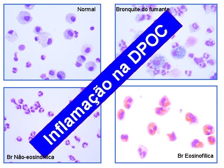 Normal o ã ç a m lf a In Br Não-eosinofílica Bronquite do fumante