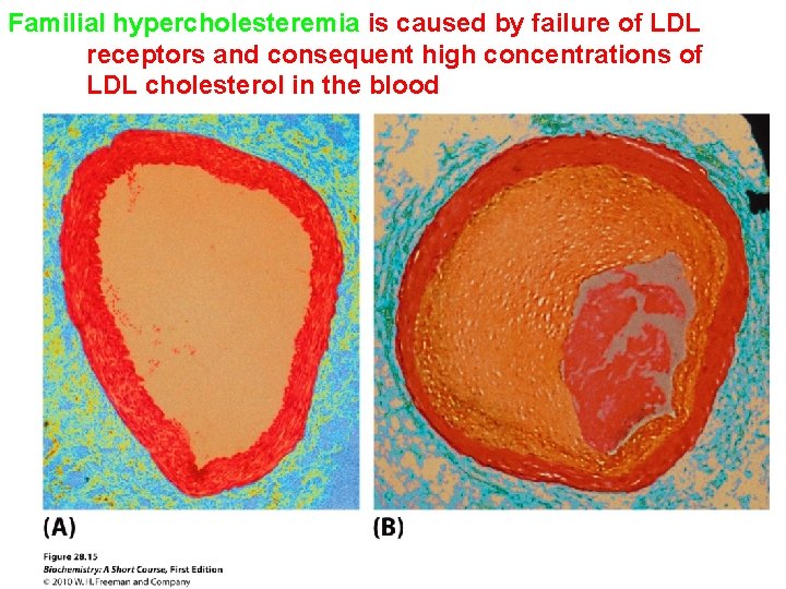 Familial hypercholesteremia is caused by failure of LDL receptors and consequent high concentrations of Familial hypercholesteremia is caused by failure of LDL receptors and consequent high concentrations of