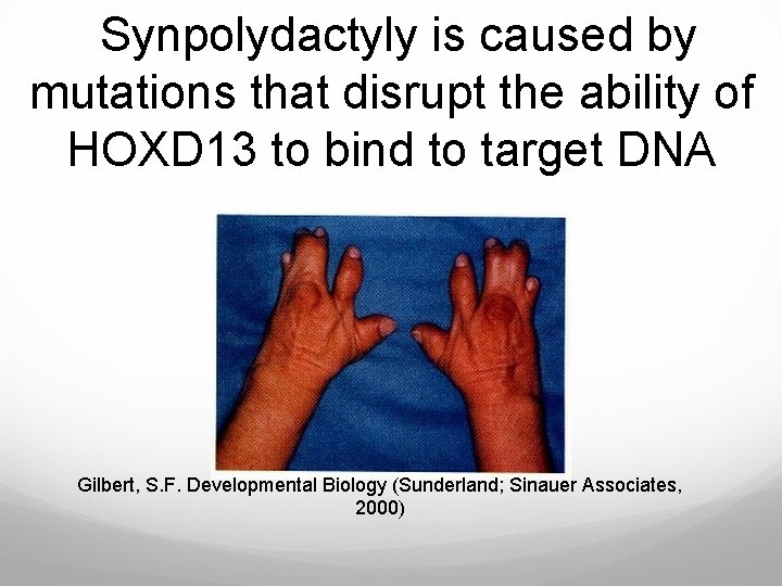 Synpolydactyly is caused by mutations that disrupt the ability of HOXD 13 to bind