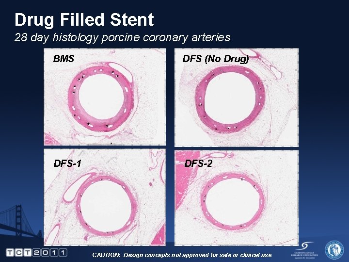Drug Filled Stent 28 day histology porcine coronary arteries BMS DFS (No Drug) DFS-1