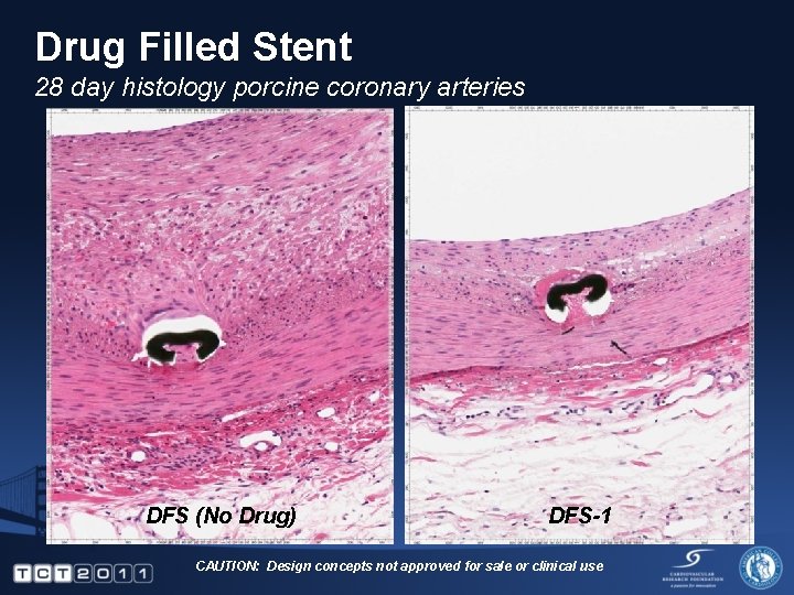 Drug Filled Stent 28 day histology porcine coronary arteries DFS (No Drug) DFS-1 CAUTION: