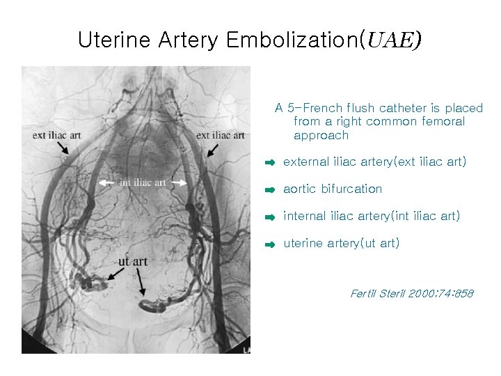 Uterine Artery Embolization(UAE) A 5 -French flush catheter is placed from a right common