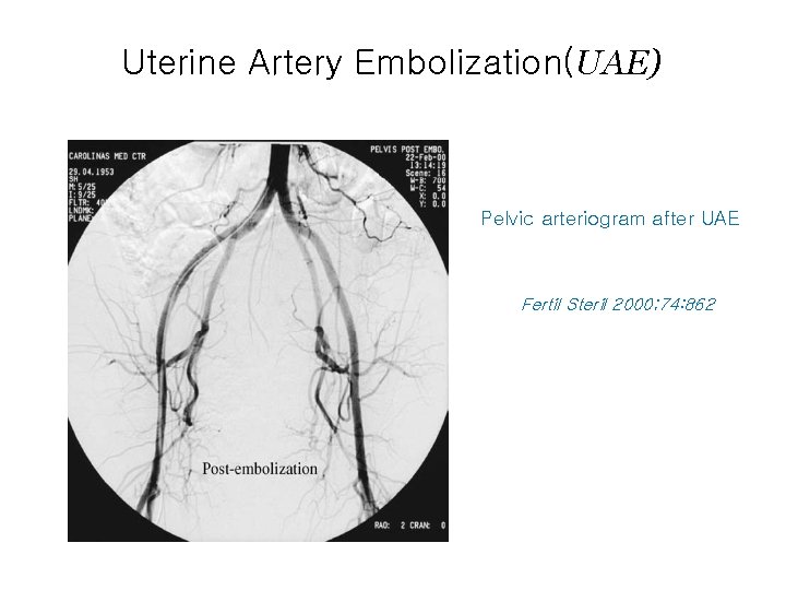 Uterine Artery Embolization(UAE) Pelvic arteriogram after UAE Fertil Steril 2000; 74: 862 