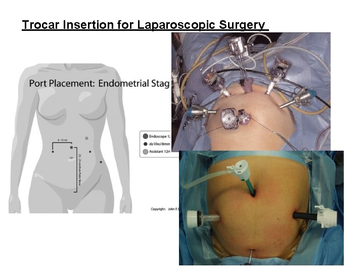 Trocar Insertion for Laparoscopic Surgery 