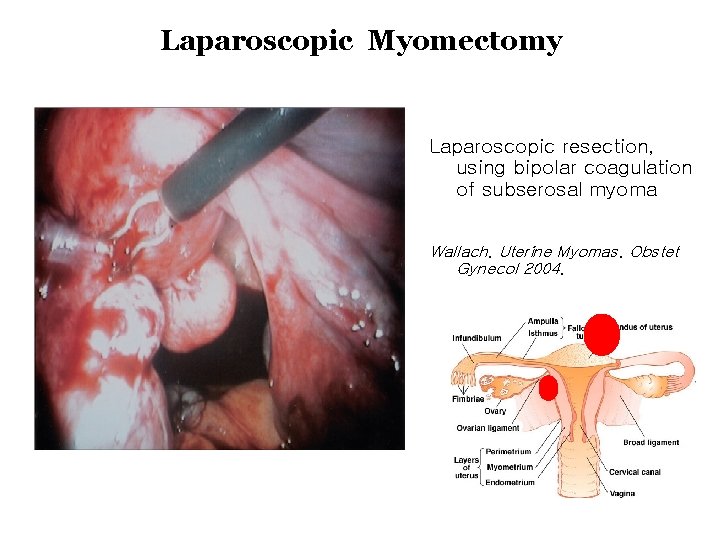 Laparoscopic Myomectomy Laparoscopic resection, using bipolar coagulation of subserosal myoma Wallach. Uterine Myomas. Obstet