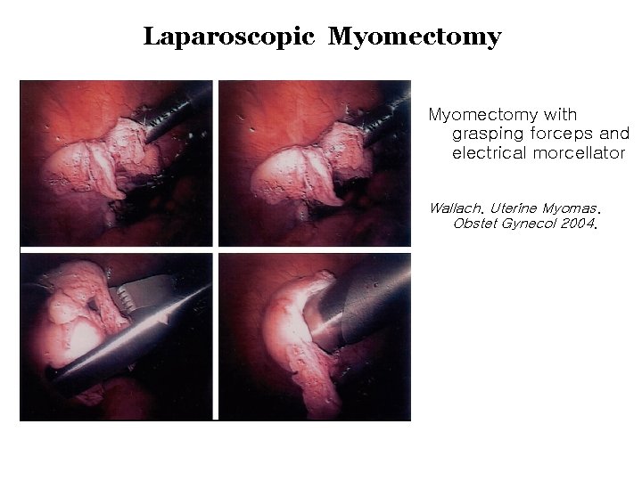 Laparoscopic Myomectomy with grasping forceps and electrical morcellator Wallach. Uterine Myomas. Obstet Gynecol 2004.