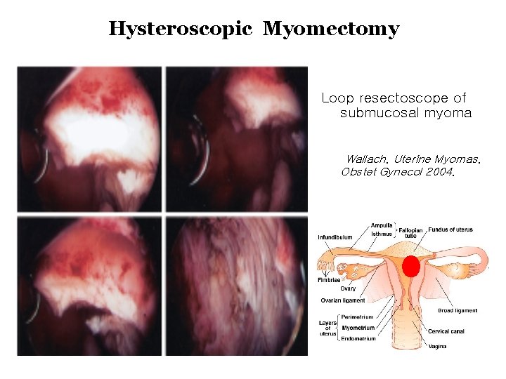 Hysteroscopic Myomectomy Loop resectoscope of submucosal myoma Wallach. Uterine Myomas. Obstet Gynecol 2004. 