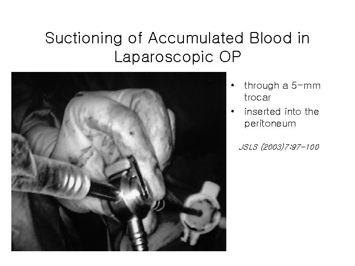 Suctioning of Accumulated Blood in Laparoscopic OP • through a 5 -mm trocar •