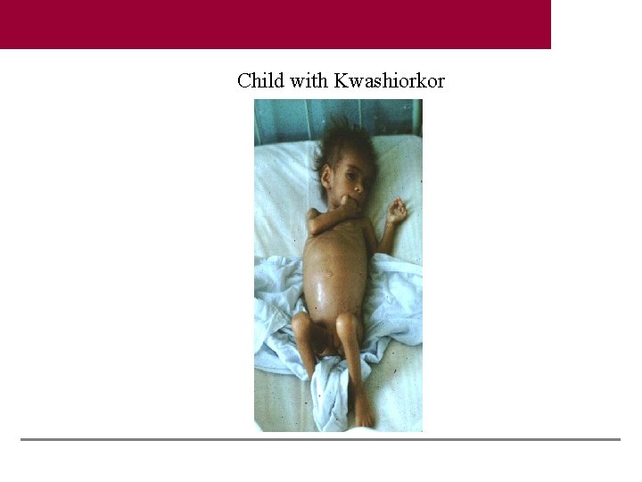 Child with Kwashiorkor 