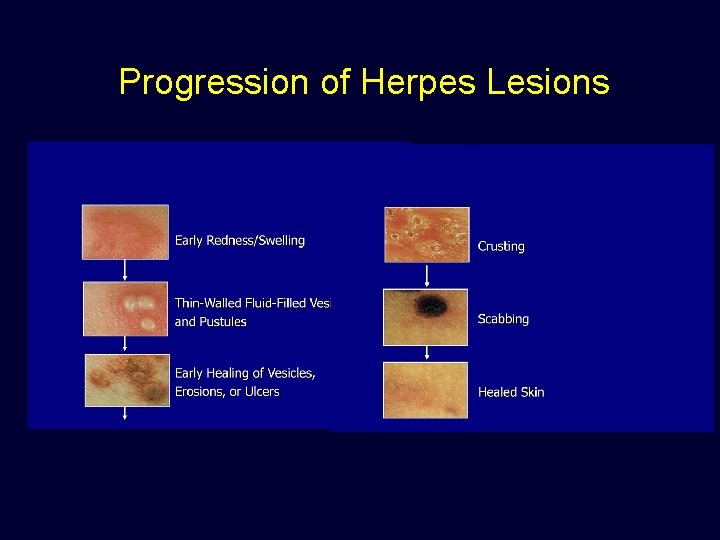 Progression of Herpes Lesions 