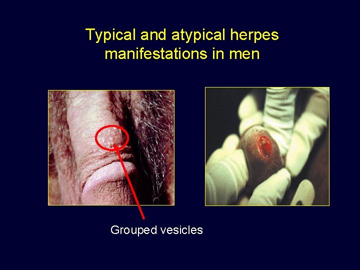 Typical and atypical herpes manifestations in men Grouped vesicles 