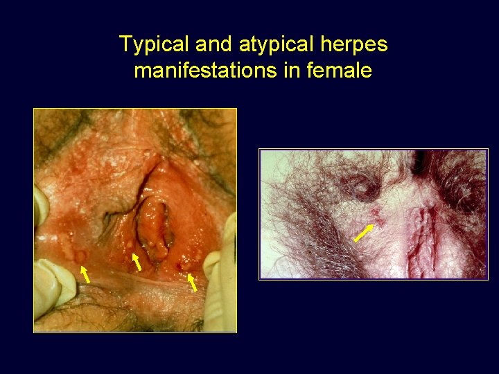 Typical and atypical herpes manifestations in female 