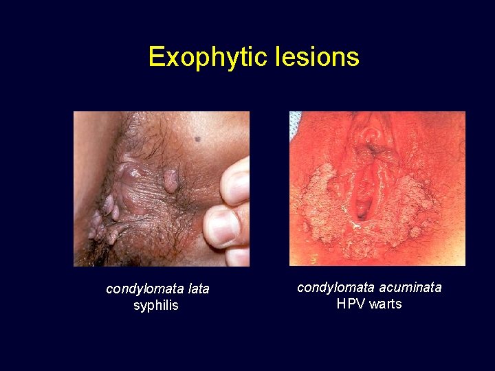 Exophytic lesions condylomata lata syphilis condylomata acuminata HPV warts 